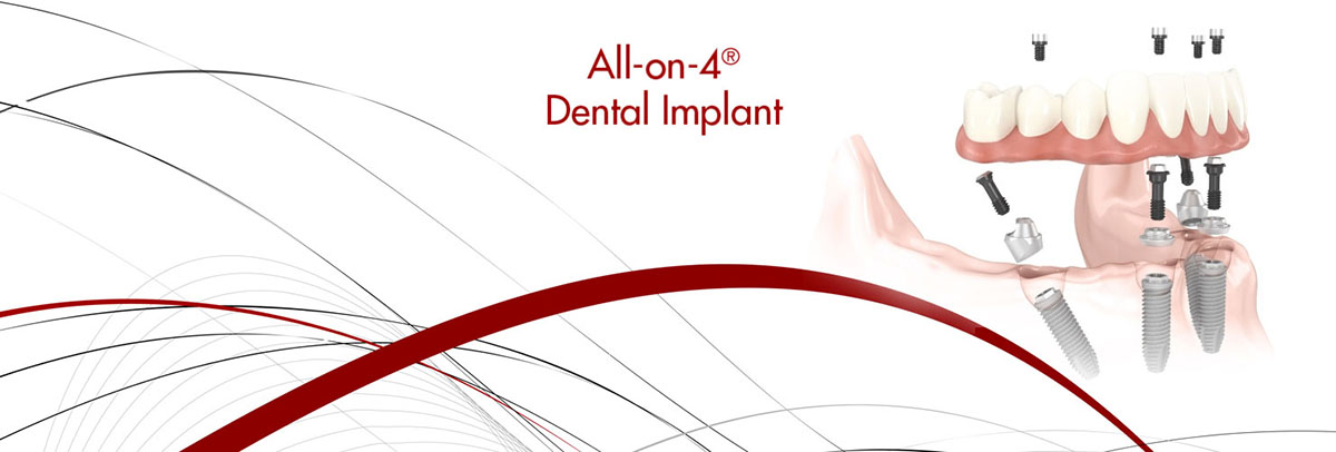 Houston All-on-4 Dental Implants