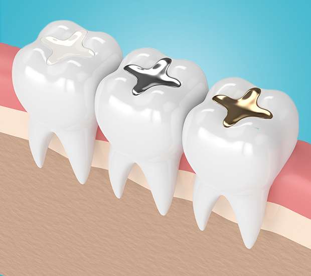 Houston Tooth Colored Fillings