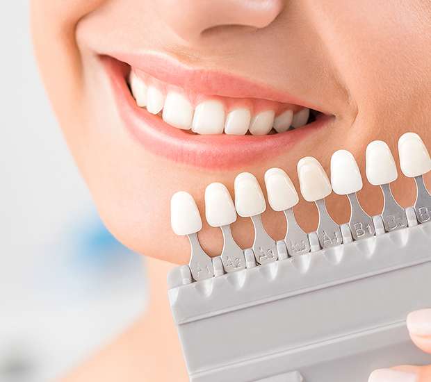 Houston Veneers