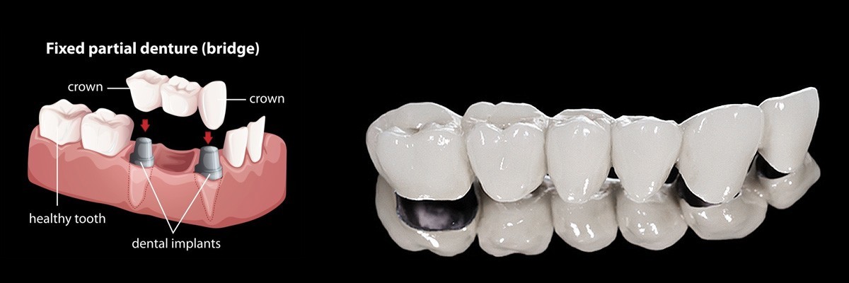 Houston Dentures