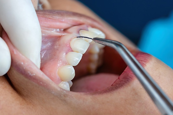 Preventing Periodontal Disease:   Signs Of Healthy Gums