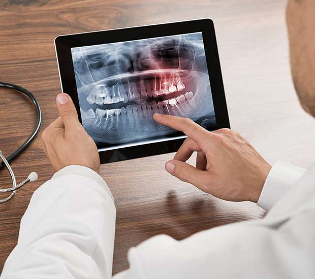 Houston Types of Dental Root Fractures