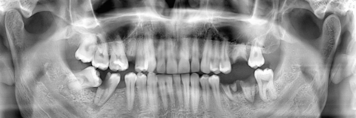 Houston Wisdom Teeth Extraction